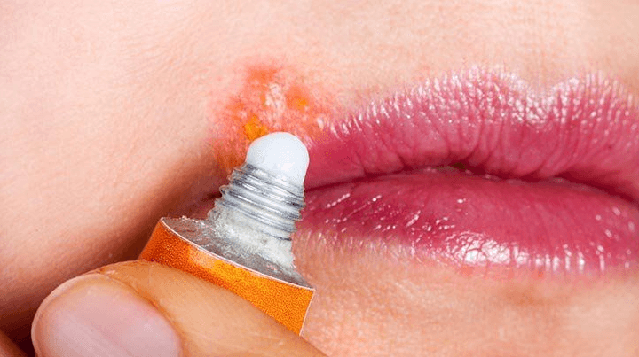 Everything You’ve Wanted to Ask About Cold Sores