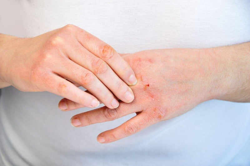 For an Itch You Just Can’t Scratch - Aussie Pharmacy