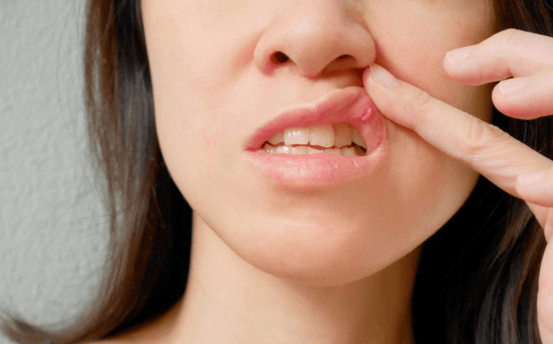 Mouth Ulcers - Aussie Pharmacy
