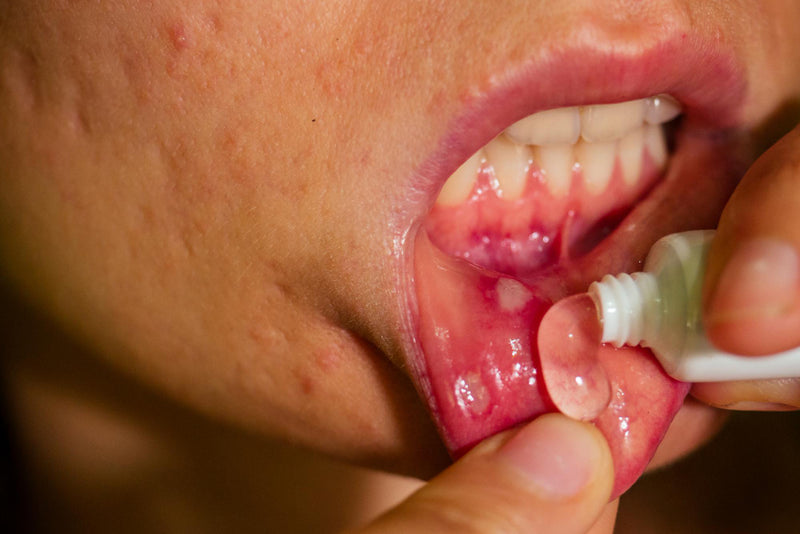 Unwelcome, Unexpected, and Uninvited: When Mouth Ulcers Pay a Visit - Aussie Pharmacy